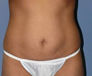 Body Contouring Before & After Image