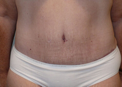 Body Contouring Before & After Image