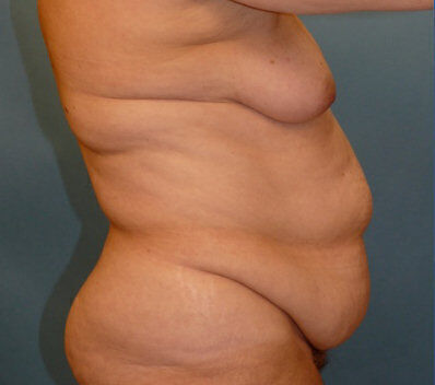 Body Contouring Before & After Image