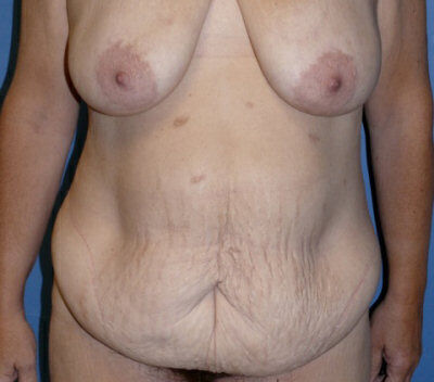 Body Contouring Before & After Image