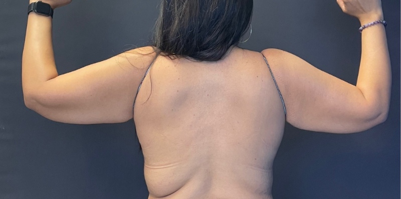 Brachioplasty Before & After Image