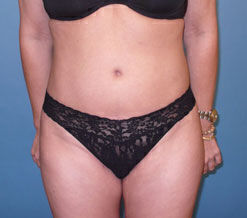 Liposuction Before & After Image