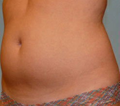 Liposuction Before & After Image