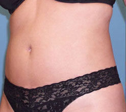 Liposuction Before & After Image