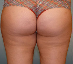 Liposuction Before & After Image