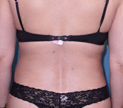 Liposuction Before & After Image