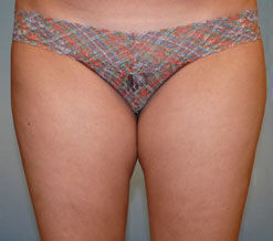 Liposuction Before & After Image