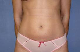 Liposuction Before & After Image