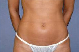 Liposuction Before & After Image