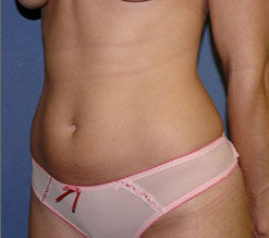 Liposuction Before & After Image