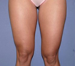 Liposuction Before & After Image