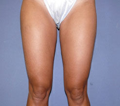 Liposuction Before & After Image