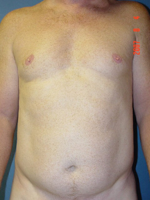 Liposuction Before & After Image