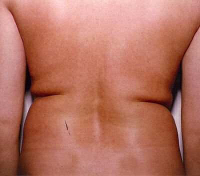 Liposuction Before & After Image