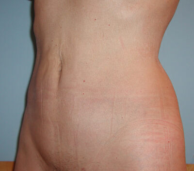 Liposuction Before & After Image