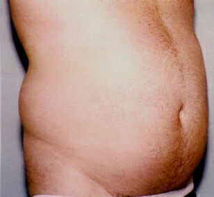 Liposuction Before & After Image