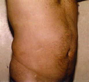 Liposuction Before & After Image