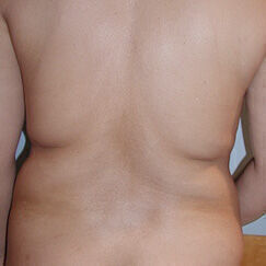 Liposuction Before & After Image