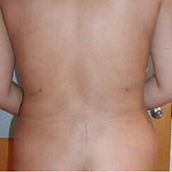 Liposuction Before & After Image