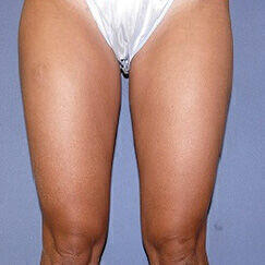 Liposuction Before & After Image