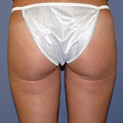 Liposuction Before & After Image