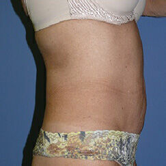 Liposuction Before & After Image