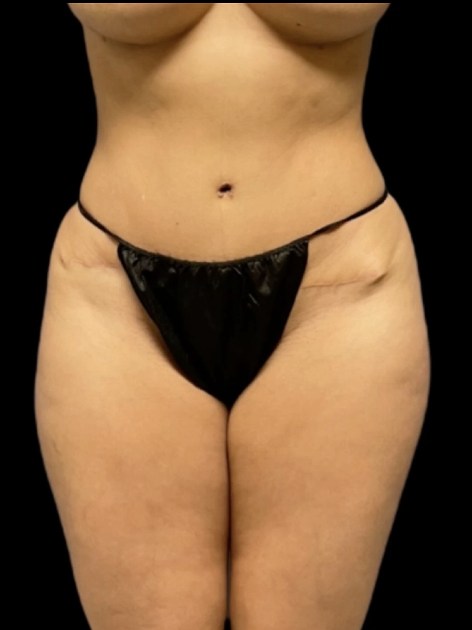 Revision Brazilian Butt Lift Before & After Image