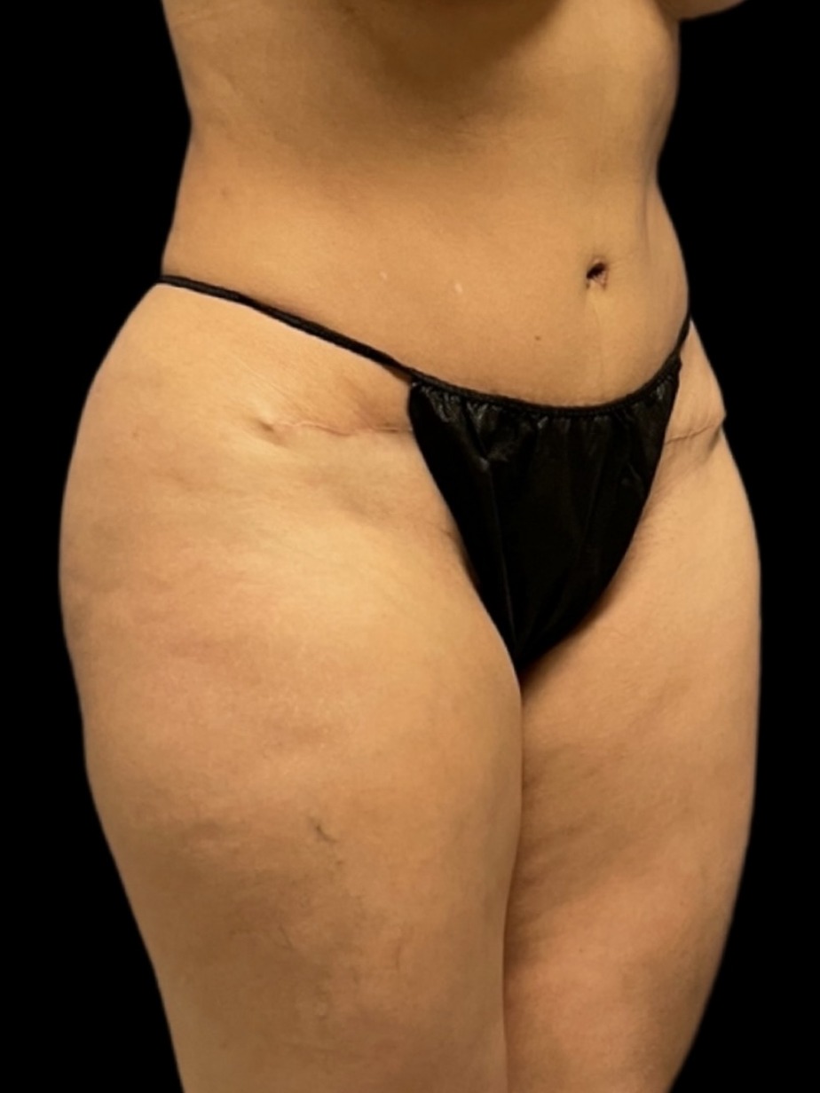 Revision Brazilian Butt Lift Before & After Image