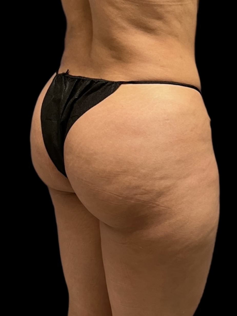 Revision Brazilian Butt Lift Before & After Image