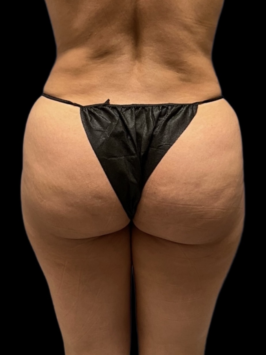 Revision Brazilian Butt Lift Before & After Image