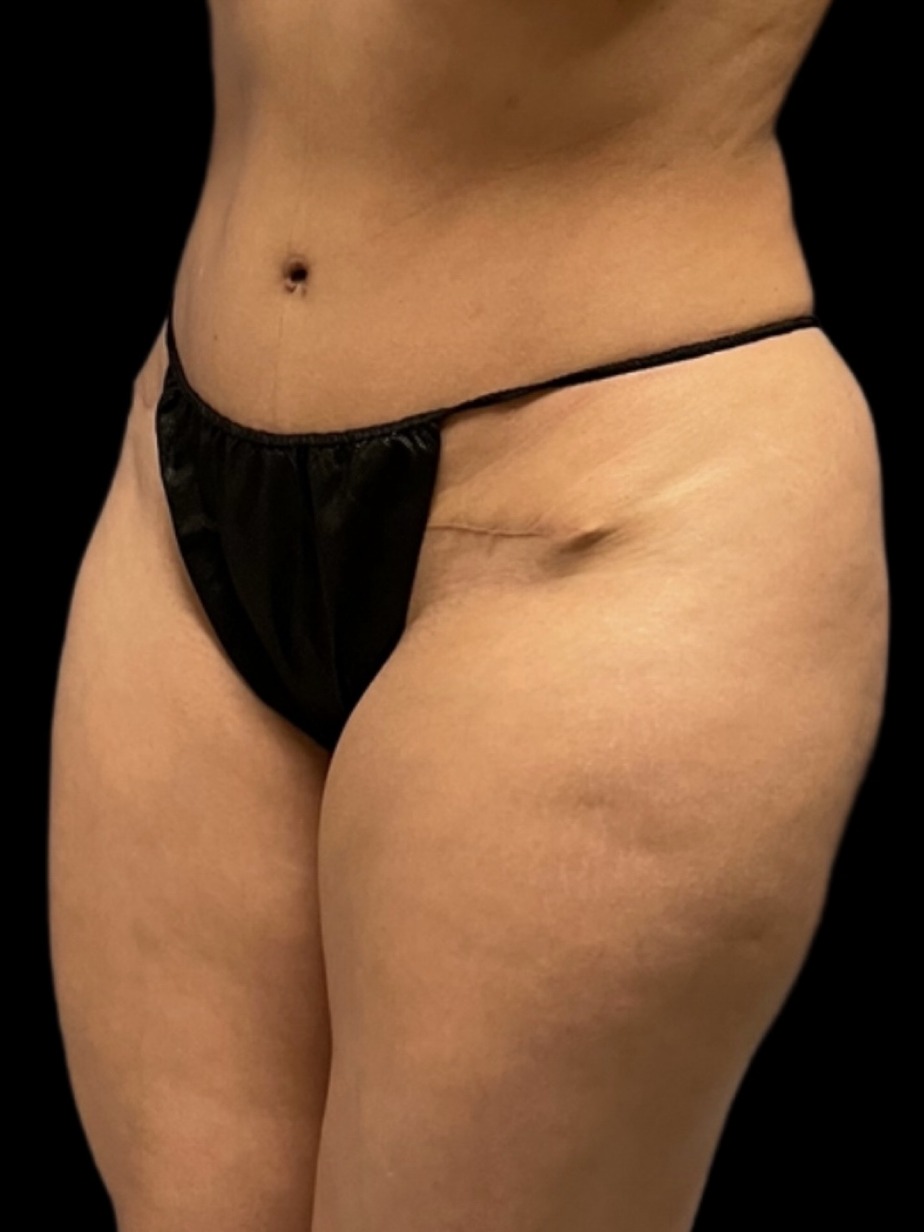 Revision Brazilian Butt Lift Before & After Image