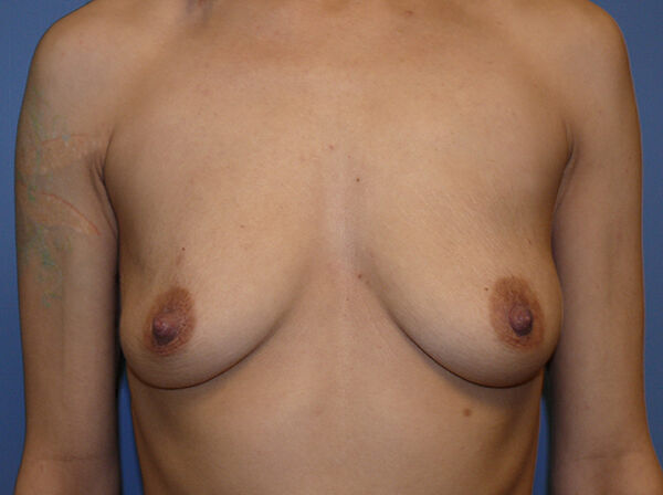 Breast Augmentation Before & After Image