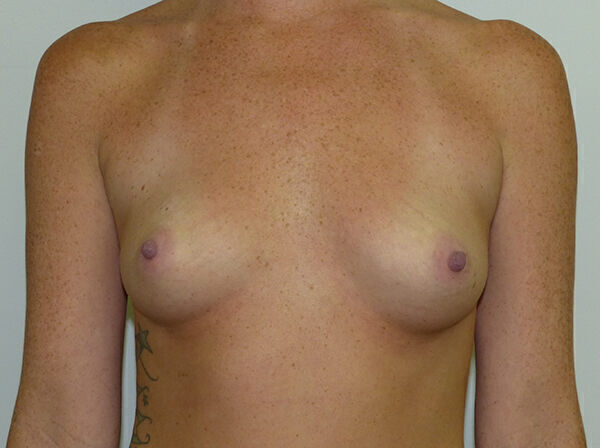 Breast Augmentation Before & After Image