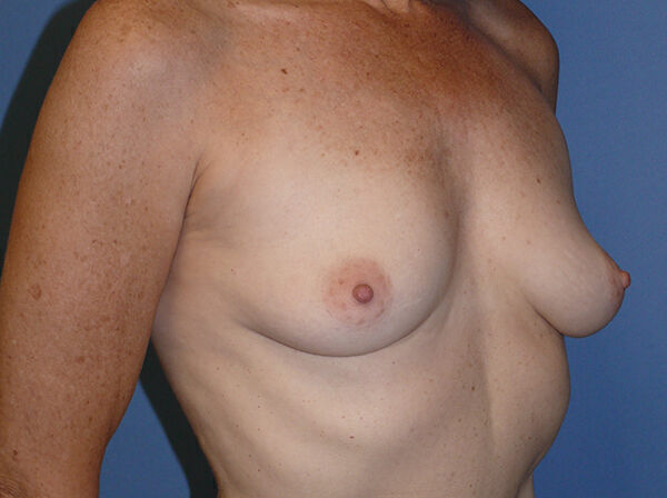 Breast Augmentation Before & After Image