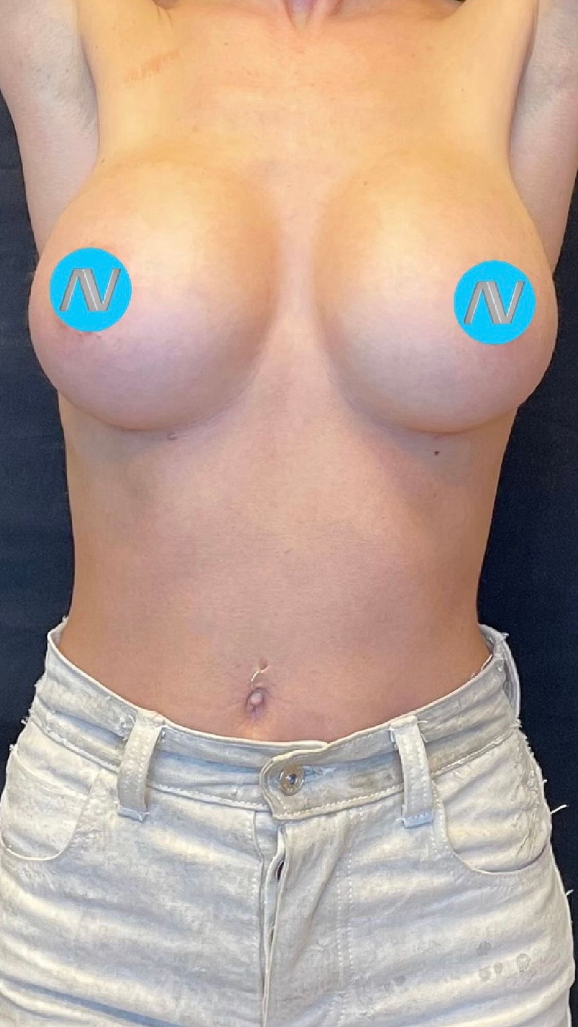 Breast Augmentation Before & After Image