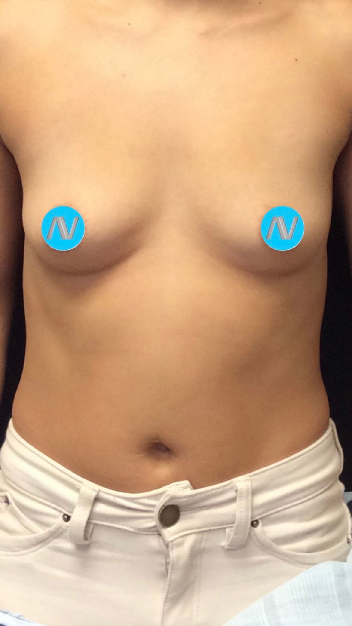 Breast Augmentation Before & After Image