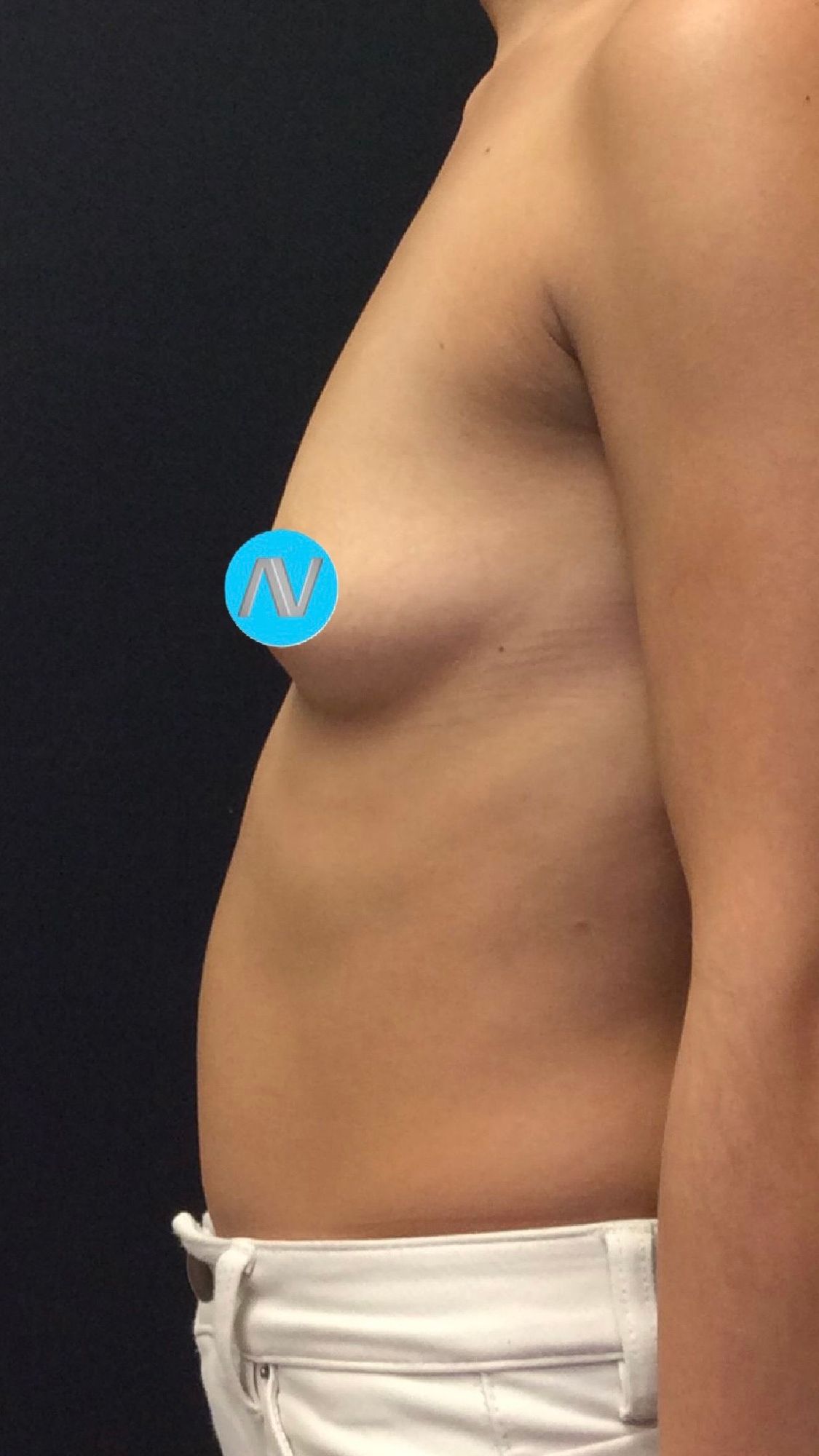 Breast Augmentation Before & After Image