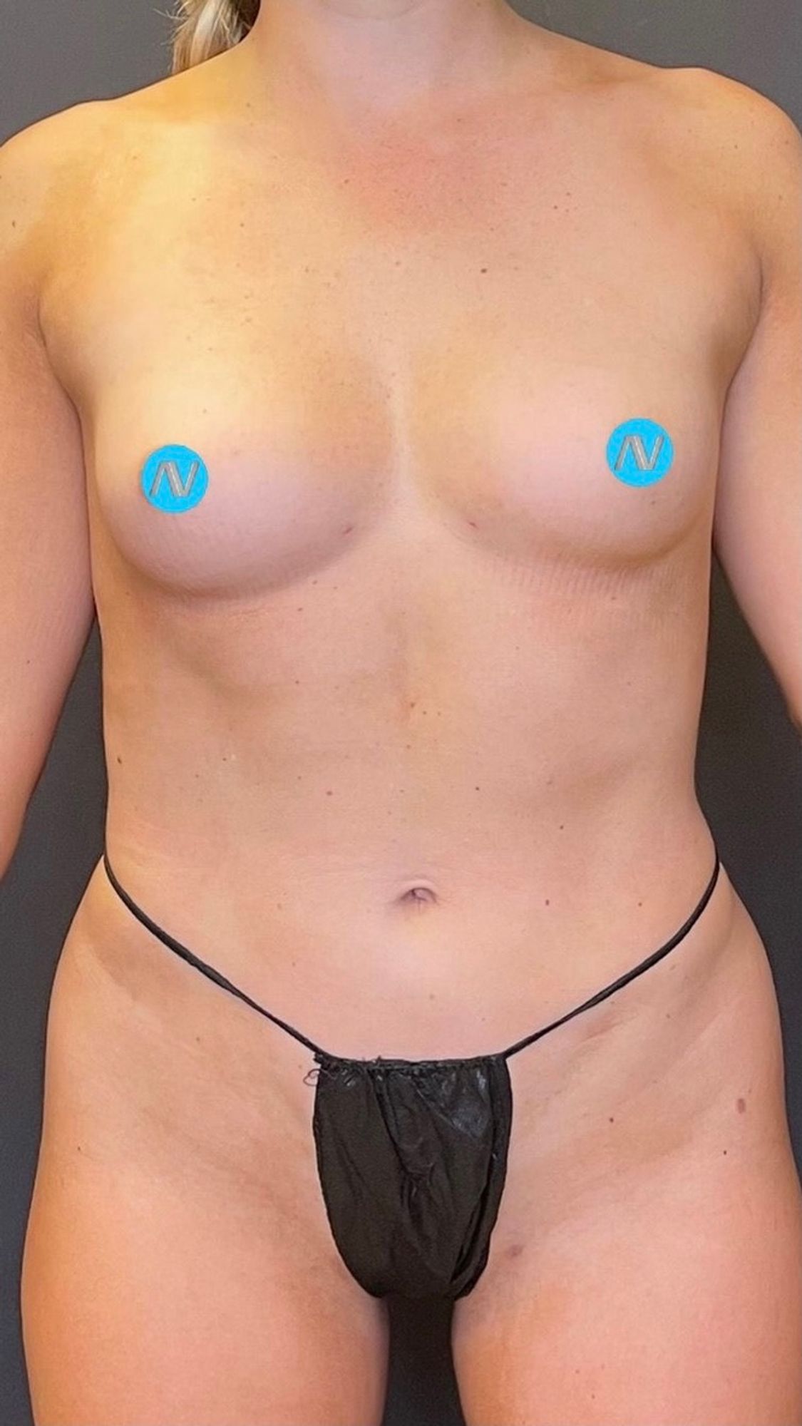 Breast Augmentation Before & After Image