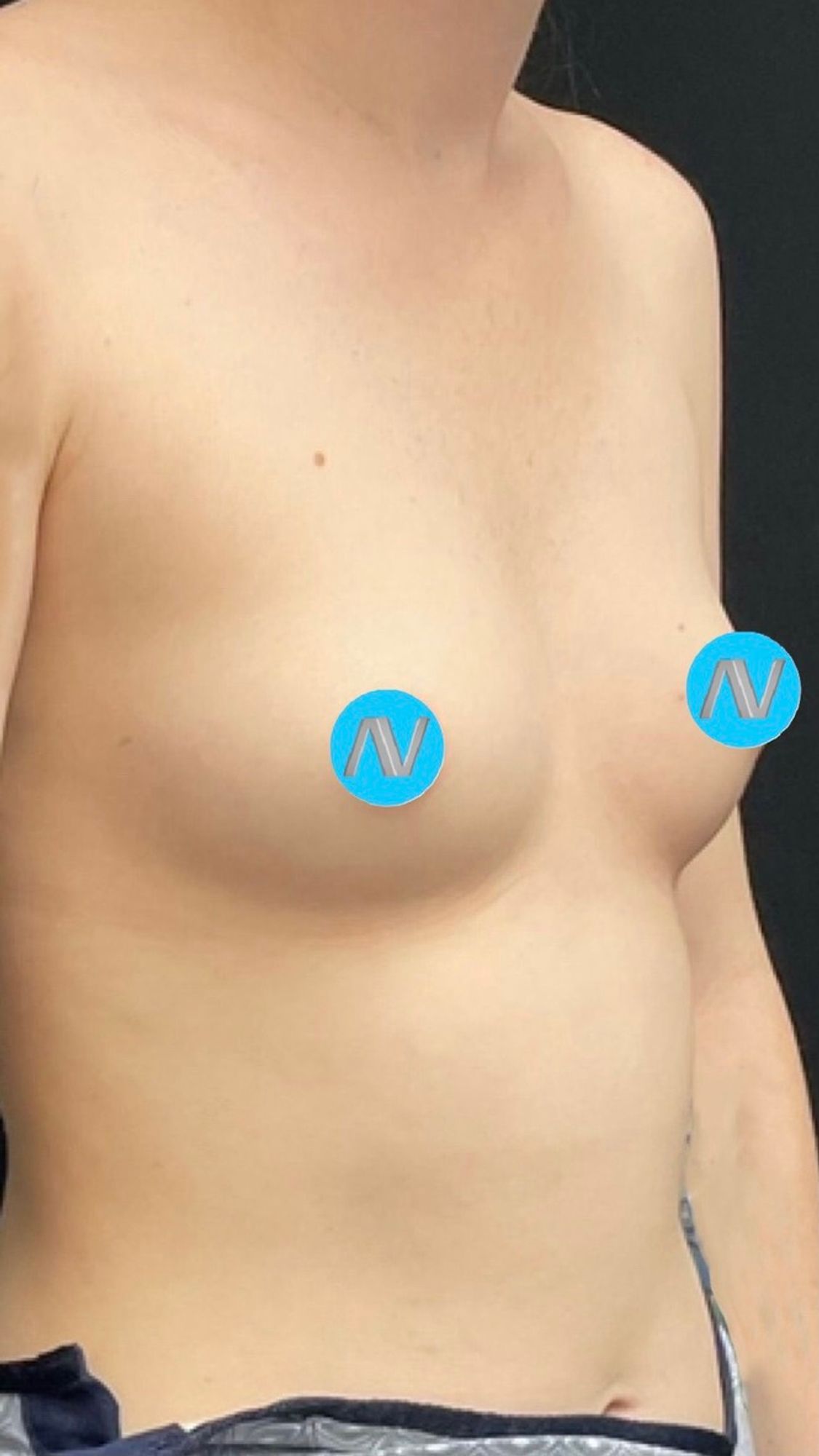 Breast Augmentation Before & After Image