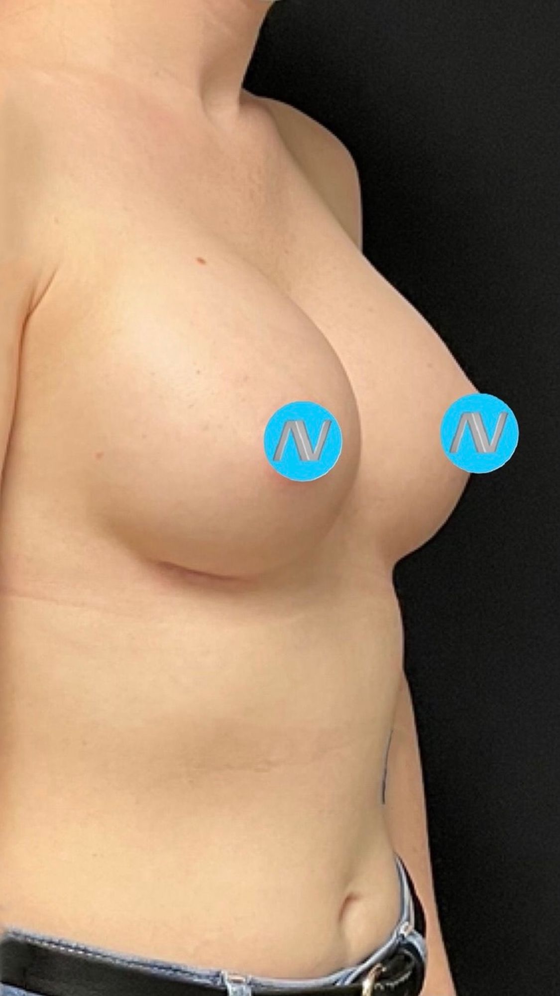 Breast Augmentation Before & After Image