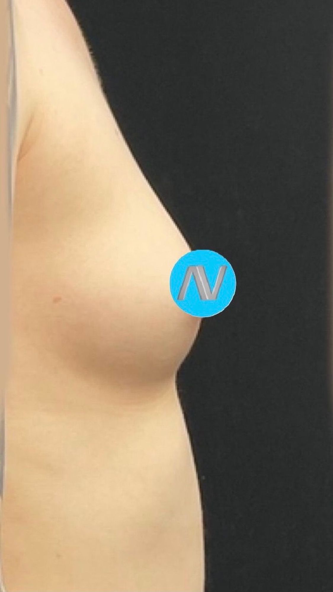 Breast Augmentation Before & After Image