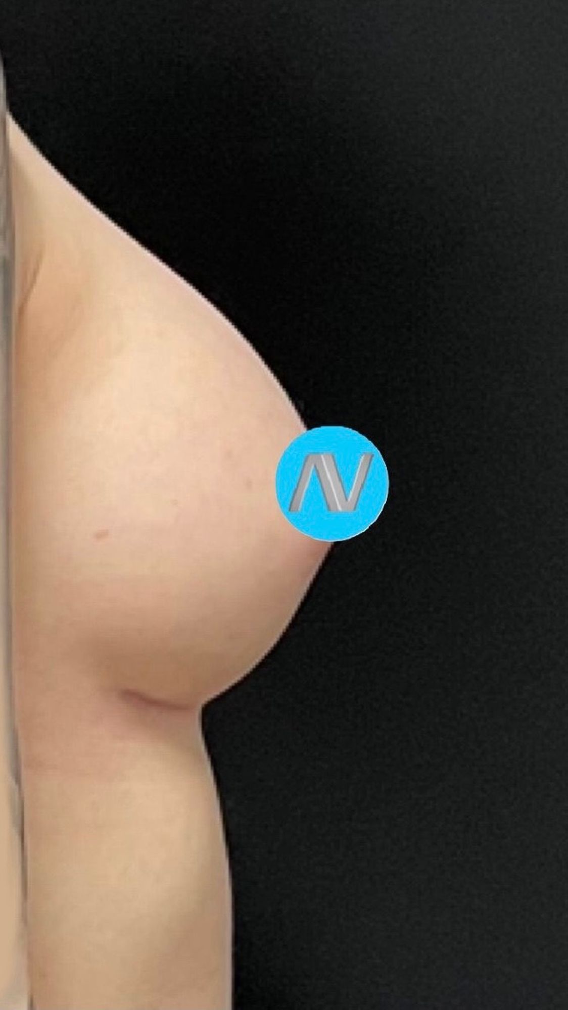 Breast Augmentation Before & After Image