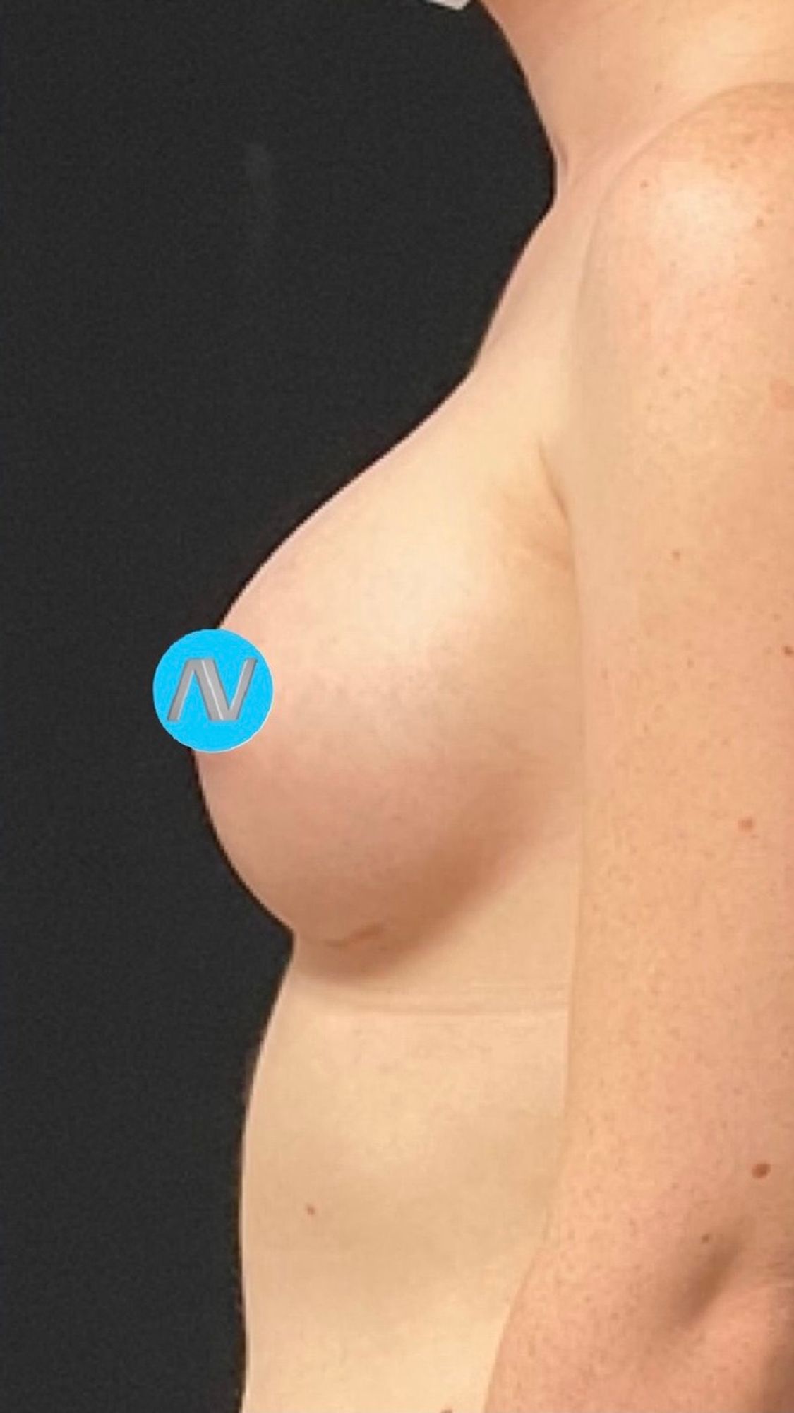 Breast Augmentation Before & After Image