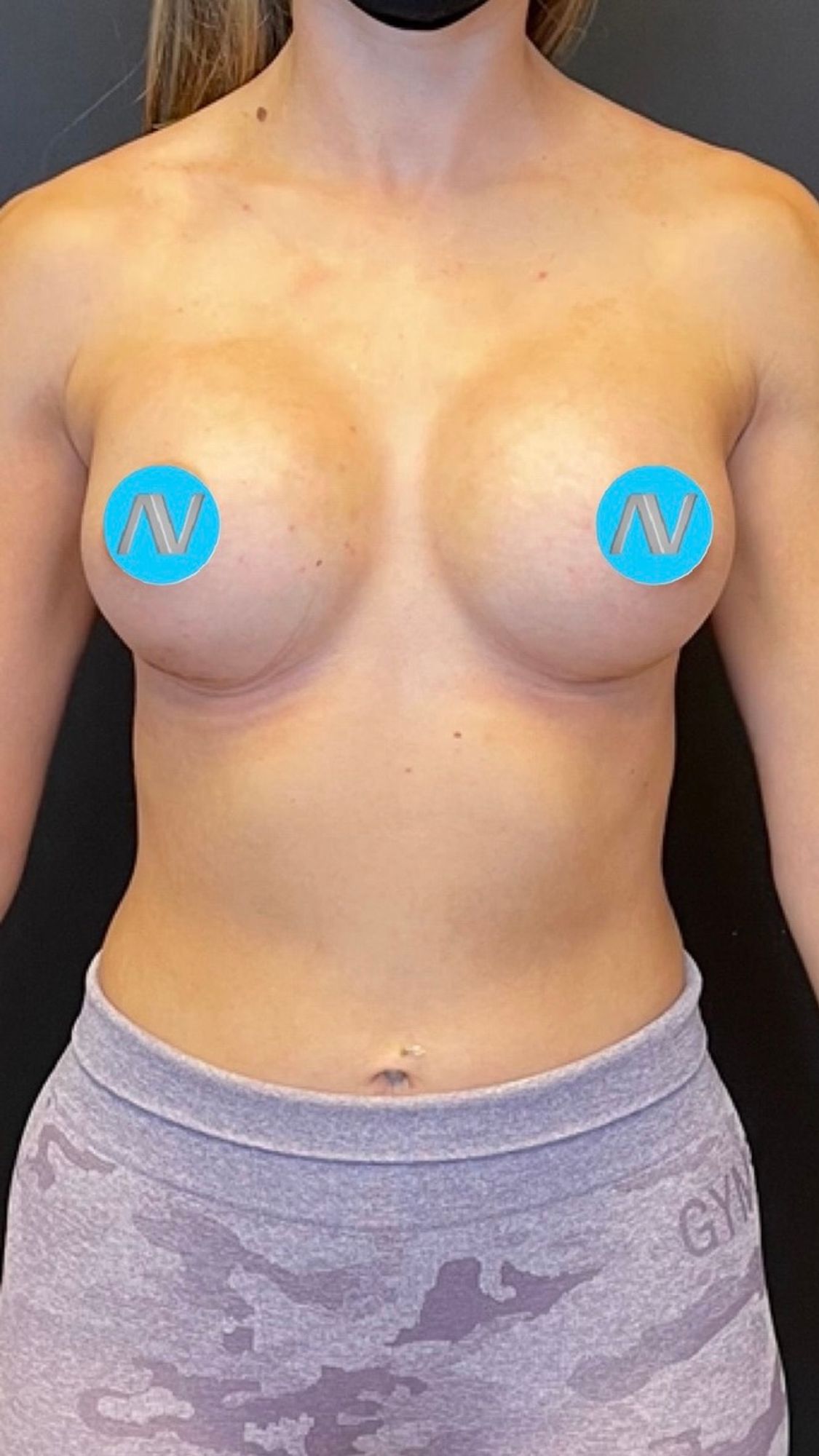 Breast Augmentation Before & After Image