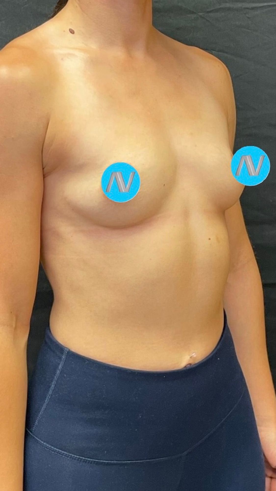 Breast Augmentation Before & After Image