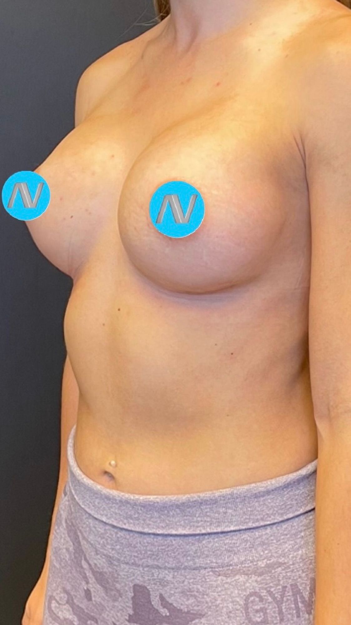 Breast Augmentation Before & After Image