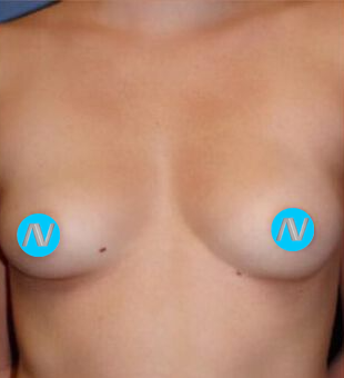 Breast Augmentation Before & After Image