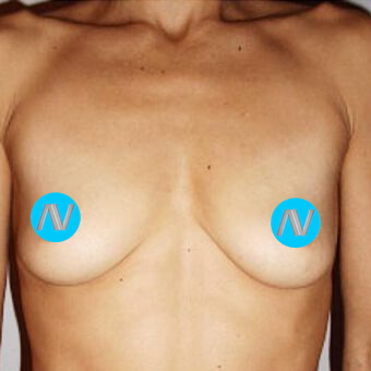 Breast Augmentation Before & After Image