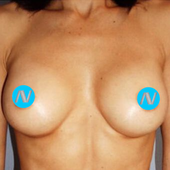 Breast Augmentation Before & After Image