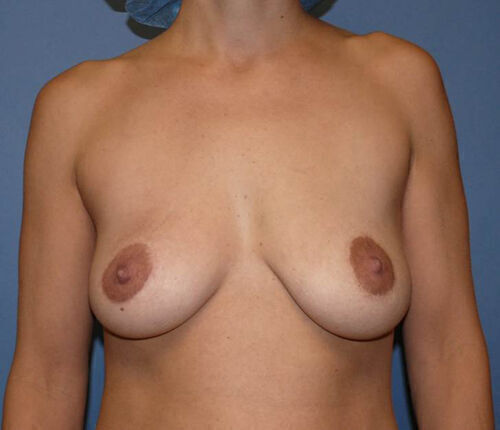 Breast Lift Before & After Image